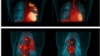 Representative human PET/CT before LZD therapy (top, left) and after 6 months of LZD therapy (top, right). PET/CT of a cynomolgus macaque before receiving LZD therapy (bottom, left) and after 2 months of LZD therapy (bottom, right). Credit: JoAnne Flynn, Teresa Coleman, Clifton Barry III.