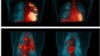 Representative human PET/CT before LZD therapy (top, left) and after 6 months of LZD therapy (top, right). PET/CT of a cynomolgus macaque before receiving LZD therapy (bottom, left) and after 2 months of LZD therapy (bottom, right). Credit: JoAnne Flynn, Teresa Coleman, Clifton Barry III.