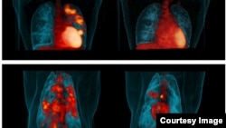 Representative human PET/CT before LZD therapy (top, left) and after 6 months of LZD therapy (top, right). PET/CT of a cynomolgus macaque before receiving LZD therapy (bottom, left) and after 2 months of LZD therapy (bottom, right). Credit: JoAnne Flynn, Teresa Coleman, Clifton Barry III.