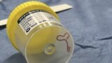 This undated photo supplied by Canberra Health Services, shows a parasite in a specimen jar at a Canberra hospital in Australia. A neurosurgeon investigating a patient's mystery neurological symptoms pulled the worm from her brain. (Canberra Health Services via AP)