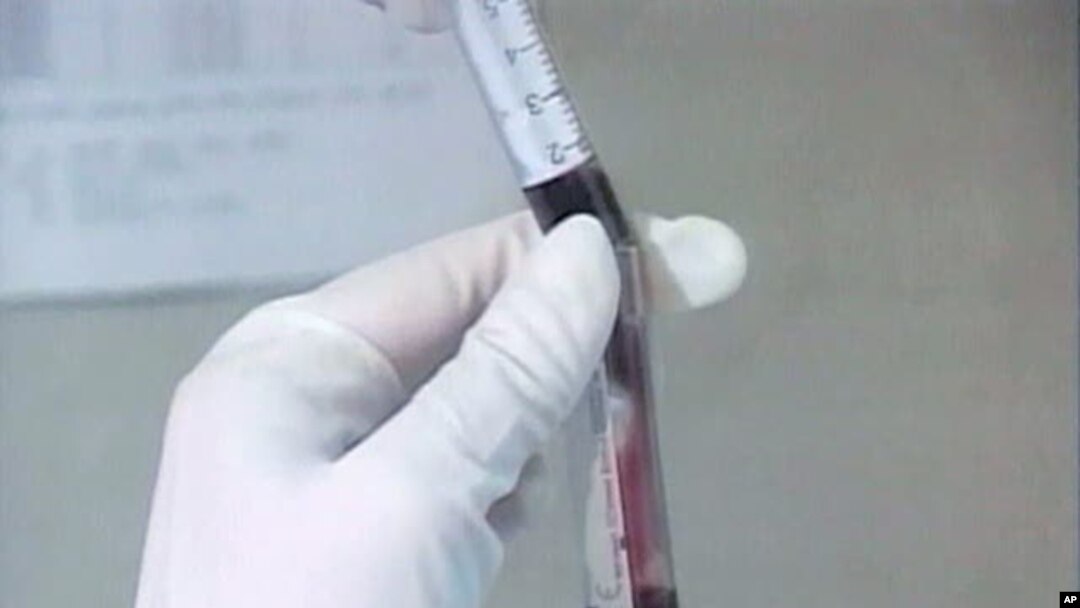 Patient, Researchers Look Back at Battle Against AIDS