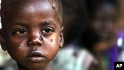 A starving child is covered with flies at the pediatric malnutrition ward at the Lilongwe Central Hospital, Malawi. (file photo)