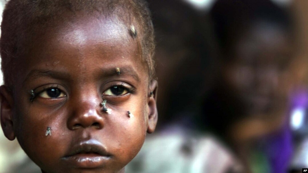 A starving child is covered with flies at the pediatric malnutrition ward at the Lilongwe Central Hospital, Malawi, April 24, 2002.