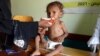UN Releases $100 Million to Battle Hunger in 6 African Countries, Yemen