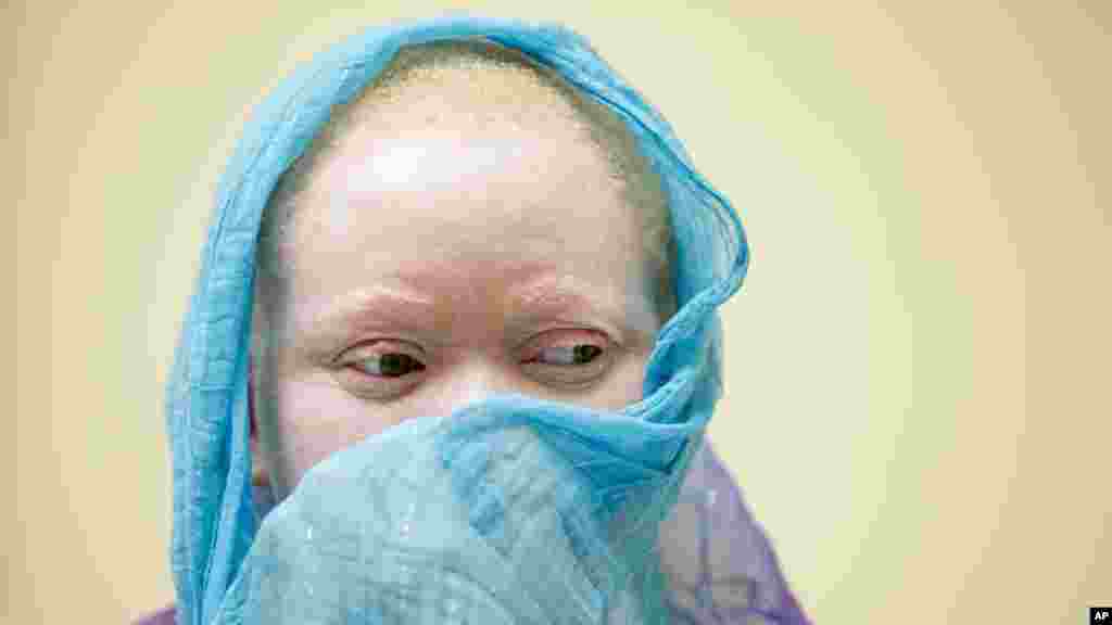 Albino Children Prosthetics