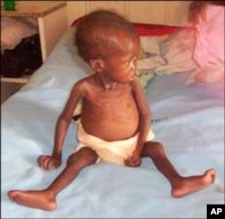 South African child shows effects of HIV infection