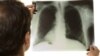 Study Reveals Alarming Levels of Drug-Resistant Tuberculosis