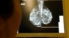 Рак груди: новые возможности 3D