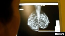 Hasil mamogram pemeriksaan dokter, jenis sinar X untuk payudara, untuk mendeteksi tumor. 