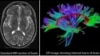 Comparison of standard brain MRI image with the three dimensional internal structure of the brain revealed by Diffusion Tensor Imaging (DTI).