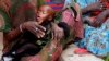 UN Warns of Alarming Malnutrition Rates in Somali Capital