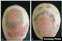 The patient's head is seen before treatment with tofacitinib and two months into treatment. (Yale University)
