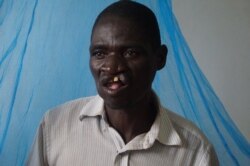 Rice James said that before the surgery to repair his cleft, he used to face insults and discrimination. (VOA/L. Masina)