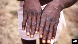 Mains d'un patient atteint de la variode du singe lors d'une épidémie en 1997 en RDC. (Archives - CDC via AP)