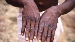 FILE—This 1997 image provided by the CDC during a probe into an outbreak of monkeypox in the DRC depicts the dorsal surfaces of the hands of a monkeypox case patient, who was displaying the characteristic rash during its recuperative stage.