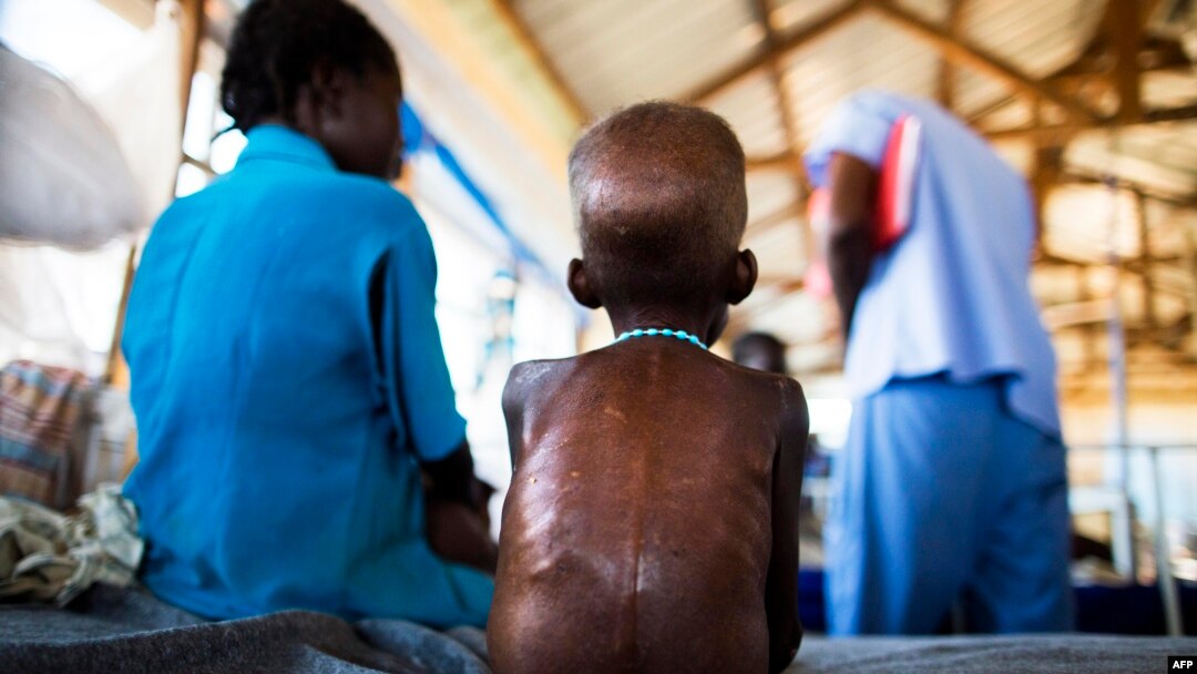 Seorang anak yang menderita kurang gizi parah dirawat di rumah sakit Northern Bahr El-Gazhal, Sudan Selatan (foto: dok).