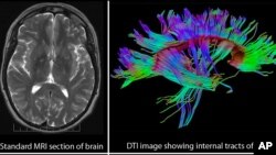 Comparison of standard brain MRI image with the three dimensional internal structure of the brain revealed by Diffusion Tensor Imaging (DTI).