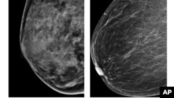 Esta radiografía del American College of Radiology muestra un pecho extremamente denso (izquierda) y otro menos denso. Un estudio ha descubierto cuatro tipos de cáncer de mama por lo que los tratamientos deben ser diferentes.