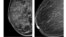 Esta radiografía del American College of Radiology muestra un pecho extremamente denso (izquierda) y otro menos denso. Un estudio ha descubierto cuatro tipos de cáncer de mama por lo que los tratamientos deben ser diferentes.