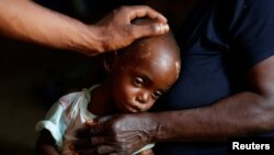 Kaba Bitika Marie, 19 mois, déplacé et souffrant de malnutrition sévère reçoit des soins médicaux à l'hôpital presbytérien de Dibindi, dans la région de Mbuji Mayi dans la province du Kasaï Oriental, RDC, 16 mars 2018.