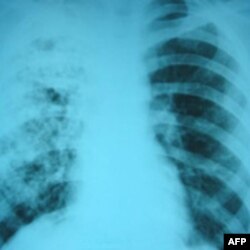 Snimak pluća pacijenta sa tuberkolozom