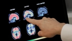 Quiz - AI Method Developed to Identify Parkinson’s Disease