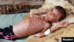 FILE - Malnourished boy Hassan Merzam Muhammad, lies on a bed at his house in Abs district of Hajjah province, Yemen July 17, 2020. REUTERS/Eissa Alragehi/File photo