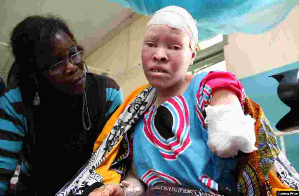 On February 11, 2013, Maria Chambanenge, a 39-year-old woman with albinism, was attacked by five armed men, allegedly including her husband, in Mkowe village, Rukwa region, Tanzania. (Under The Same Sun) 