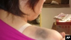 李春华出示被打伤痕