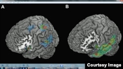 Lesion overlap analysis for the FoP group (A) revealed three regions where overlap was maximal: temporo- parietal, insular, and especially (when comparing to a control group, B) fronto -parietal cortex. ©Current Biology