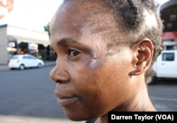 This woman carries the scars of a near-fatal car smash, like many thousands of South Africans.