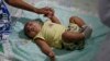 یک کودک سه ماهه در برزیل، کشوری که نوزادان بسیاری به خاطر ویروس زیکا جمجمه کوچی دارند.