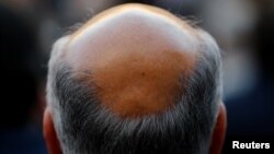 A new study has found that males of short stature are at increased risk of losing their hair prematurely, in addition to a number of other health conditions.