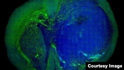 This image of a human glioblastoma brain tumor was made with stimulated Raman scattering microscopy. The technique allows the tumor (blue) to be easily distinguished from normal tissue (green) based on signals emitted by tissue with different cellular structure.