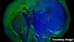 This image of a human glioblastoma brain tumor in the brain of a mouse was made with stimulated Raman scattering, or SRS, microscopy. The technique allows the tumor (blue) to be easily distinguished from normal tissue (green).