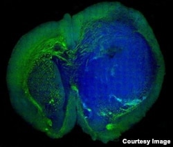 This image of a human glioblastoma brain tumor in the brain of a mouse was made with stimulated Raman scattering, or SRS, microscopy. The technique allows the tumor (blue) to be easily distinguished from normal tissue (green) based on faint signals emitte