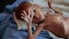 В Йемене почти 20 миллионам человек угрожает голод