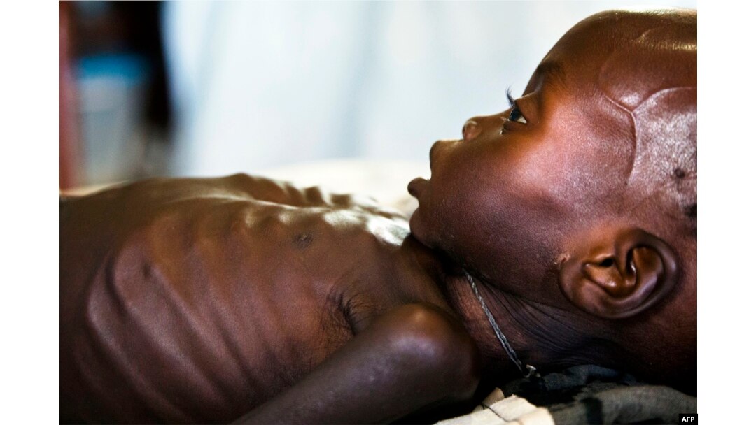 FILE - Agop Manut (11 months), who suffers acute malnutrition and respiratory distress, is assisted at the clinic run by Doctors without Borders (MSF) in Aweil, Northern Bahr al Ghazal, South Sudan, Oct. 11, 2016.