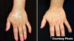 After five months of treatment with tofacitinib, the discoloration on a vitiligo patient's hands improved dramatically. (Credit: Brett King, Yale University)