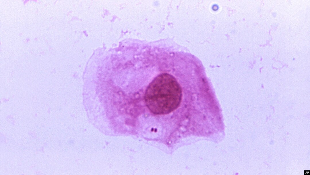 This image provided by the Centers for Disease Control and Prevention shows a photomicrograph of Neisseria meningitidis. A contagious bacterial infection appears to be the cause of at least some cases in a mysterious outbreak in Liberia, U.S. health officials said on May 8, 2017.