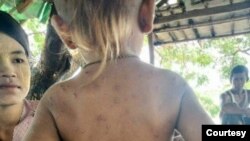 ရခိုင် စစ်ရှောင်ဒုက္ခသည်စခန်းတွေ ရေအခက်အခဲဖြစ်နေ