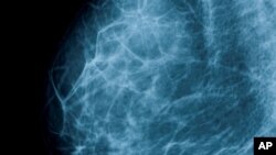 Студија најде минимална корист од скенирање за рак на дојка