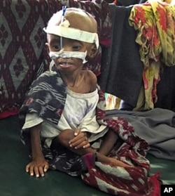 Un enfant victime de malnutrition à l'hôpital Banadir de Mogadiscio