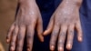 FILE - Sumaya Hatungimana, 12, shows the marks on her hands after recovering from mpox, outside her house in Kinama zone, in Bujumbura, Burundi, Aug. 28, 2024. 