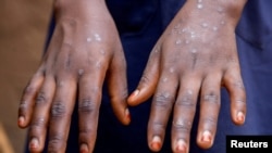 FILE - Sumaya Hatungimana, 12, shows the marks on her hands after recovering from mpox, outside her house in Kinama zone, in Bujumbura, Burundi, Aug. 28, 2024. 