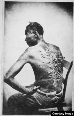 The original caption on this 1863 photograph of a slave read: "Overseer Aarayou Carrier whipped me. I was two months in bed sore from the whipping. My master come after I was whipped; he discharged the overseer." (Courtesy: The National Archives)