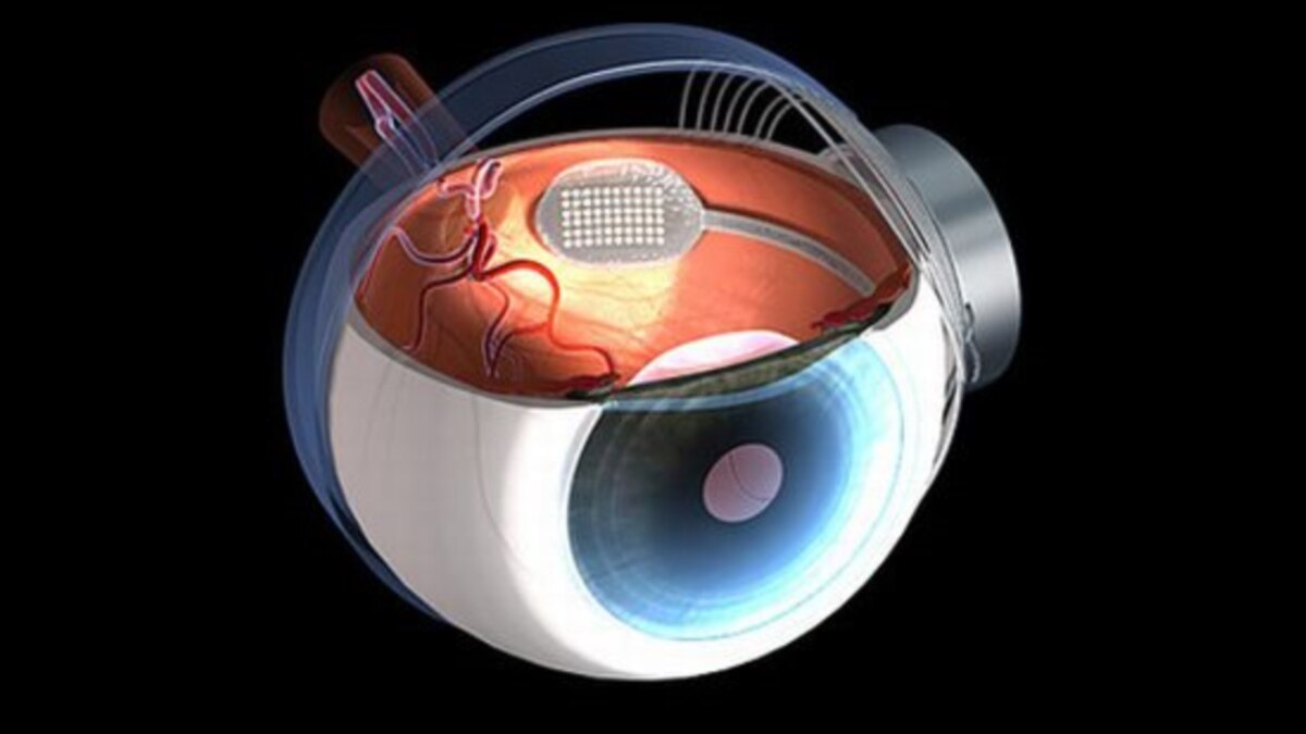 Бионический глаз. Имплант сетчатки глаза Argus 2. Бионический протез глаза. Бионические импланты сетчатки. Искусственная сетчатка нанотехнологии.