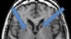 Pengaruh Stroke Ringan Jauh Lebih Berbahaya dari yang Diperkirakan