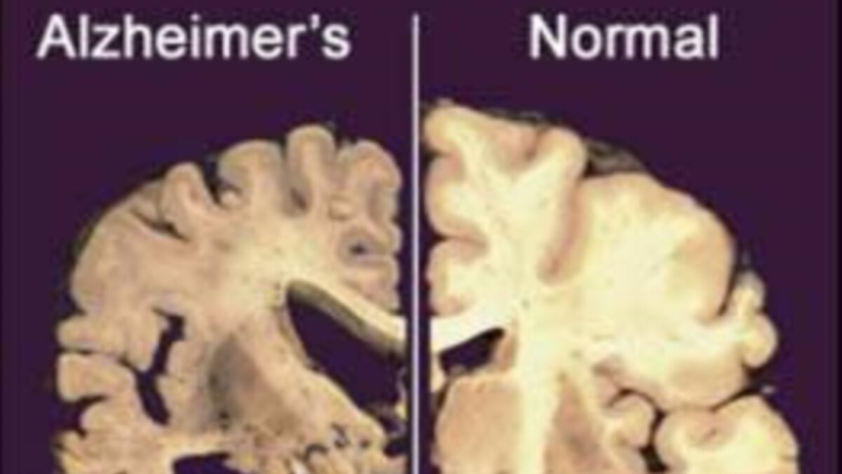 Antibody Therapy Clears Destructive Alzheimer’s Brain Plaques