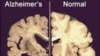 Anti-Depressant May Help Prevent Alzheimer’s Disease 